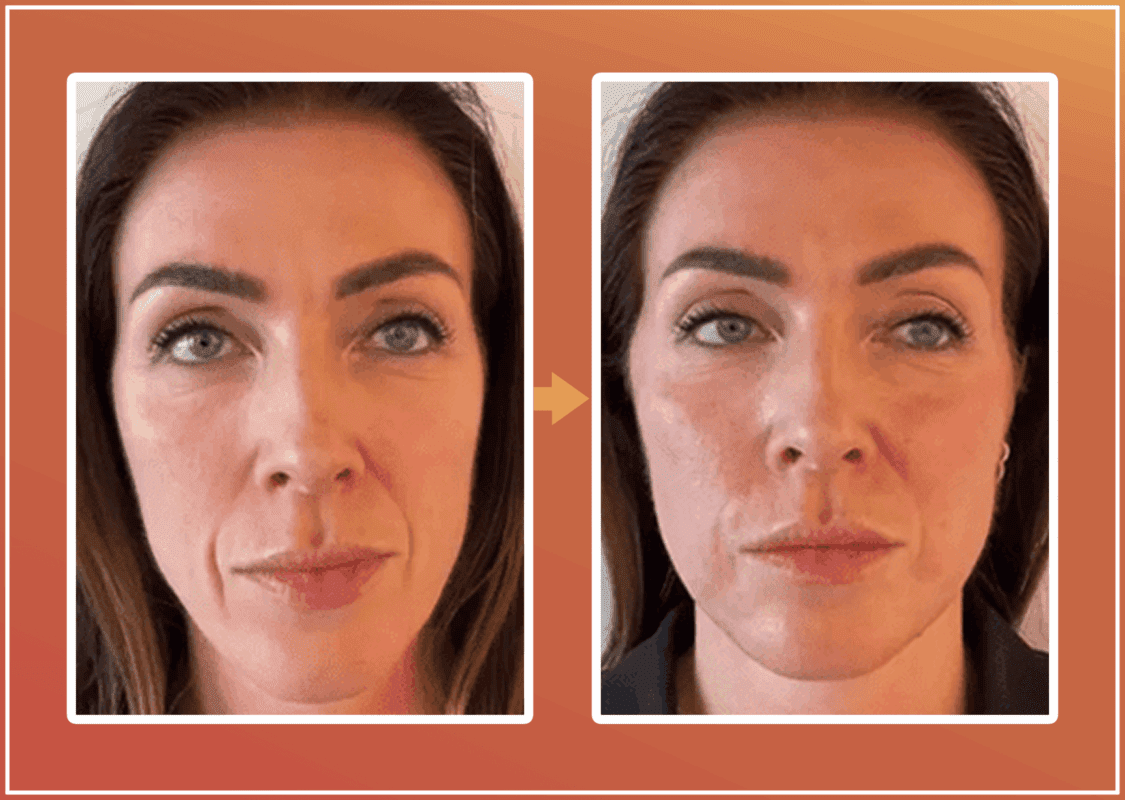 Lanluma voor en na foto met zichtbaar volumevergroting