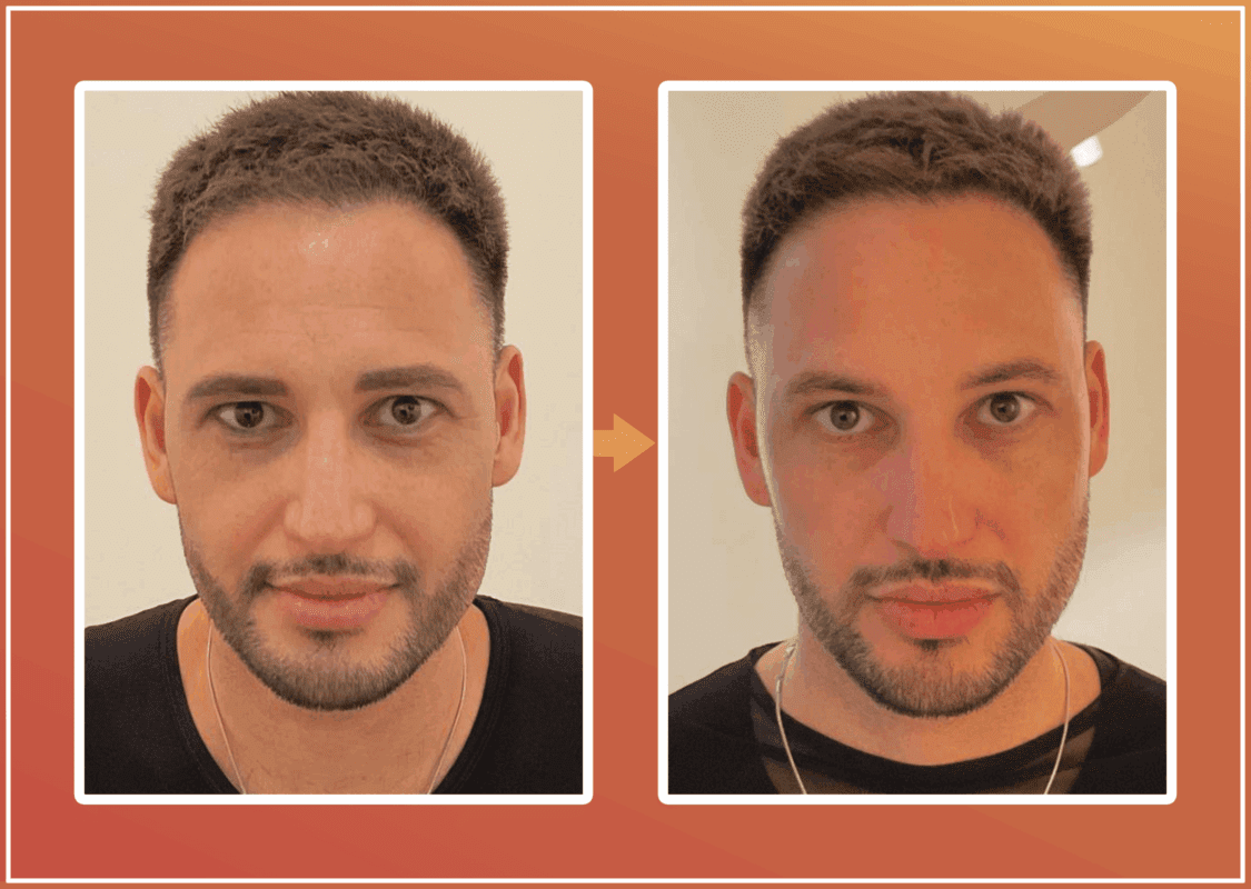 Radiesse behandeling resultaat 1