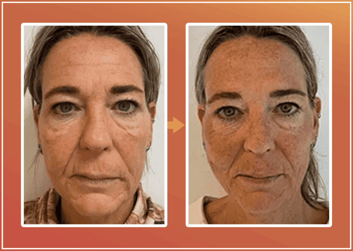 Biostimulatie behandeling resultaat