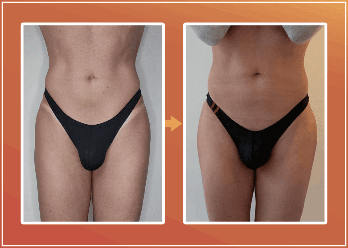 Hip dip filler resultaat