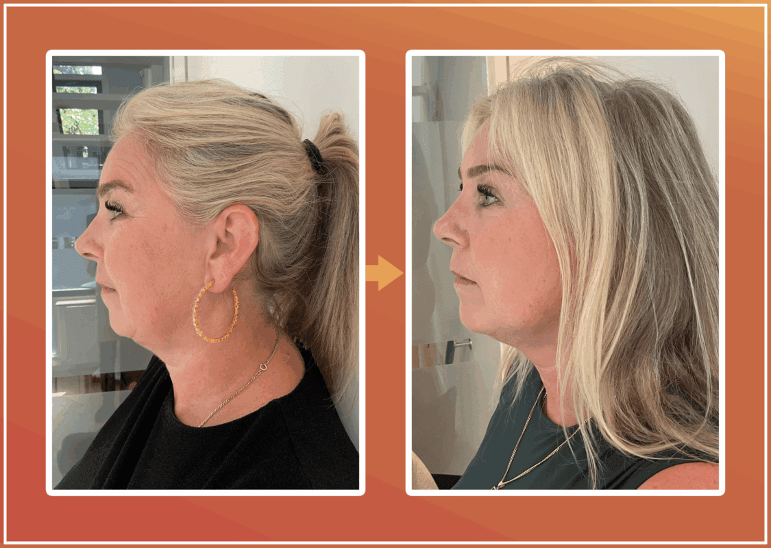 Endolift behandeling resultaat 1