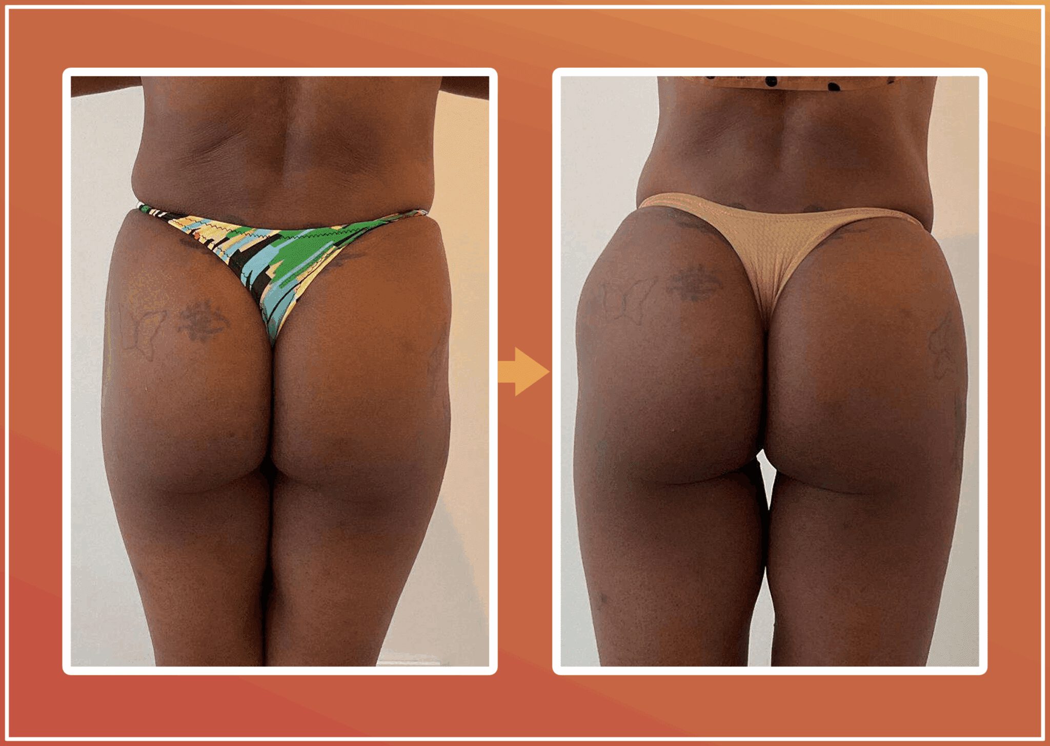 Hip dip filler resultaat