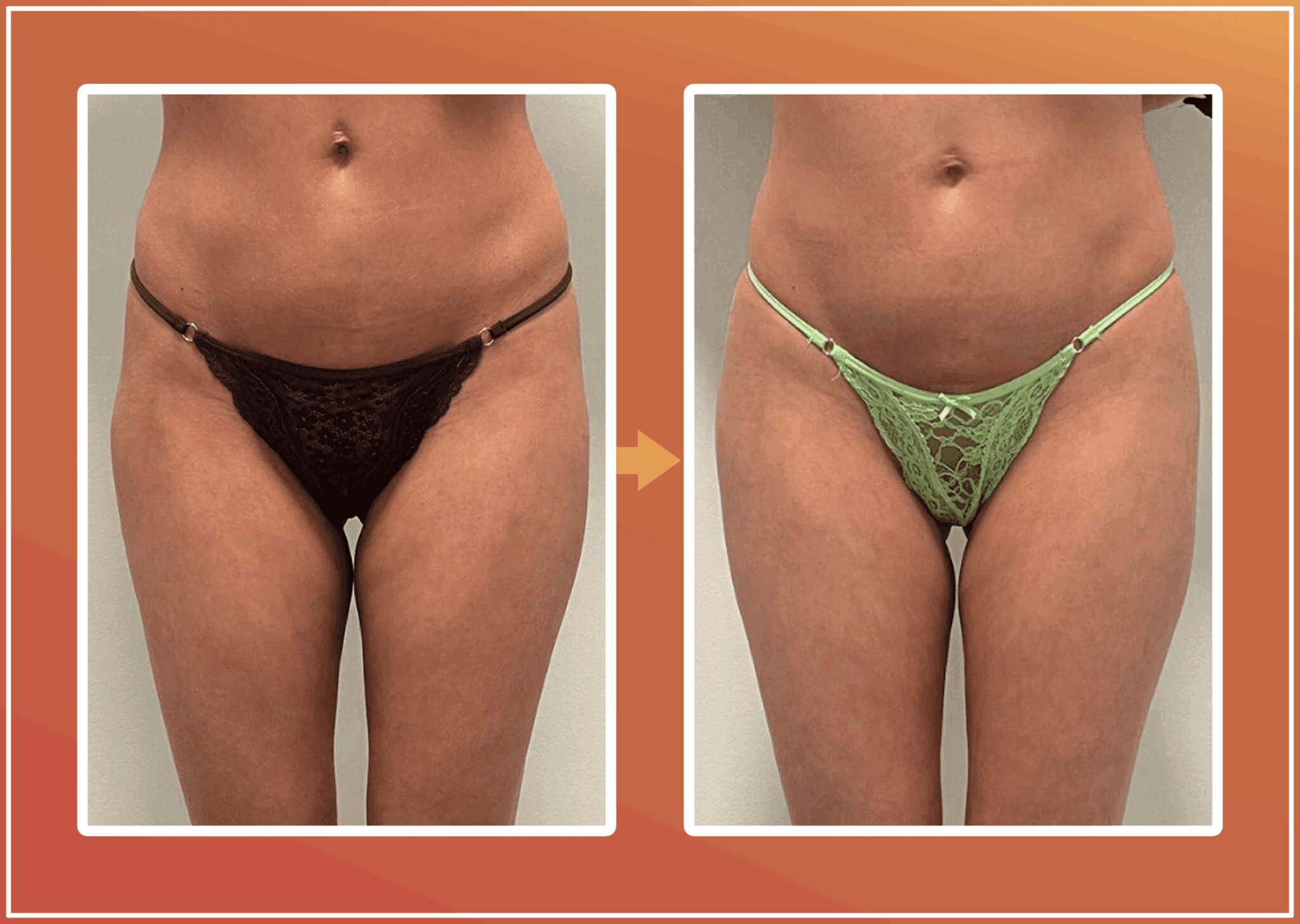 Hip dip filler resultaat