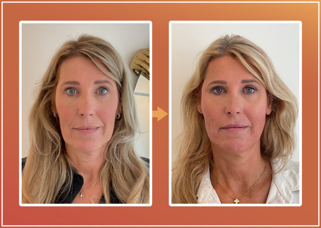 Endolift behandeling resultaat 2