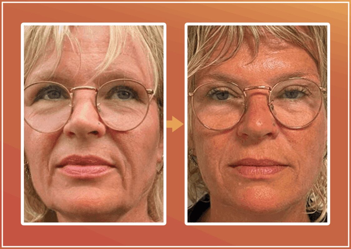 PDO draadlift voor en na foto voor jeugdige uitstraling