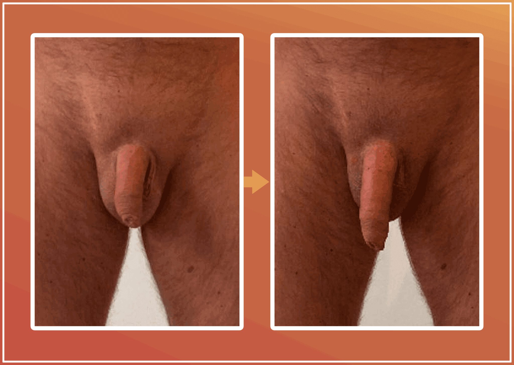 Penisvergroting resultaat