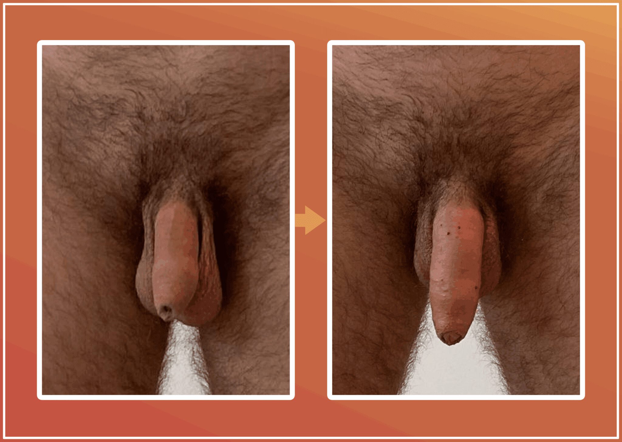 Penisvergroting resultaat