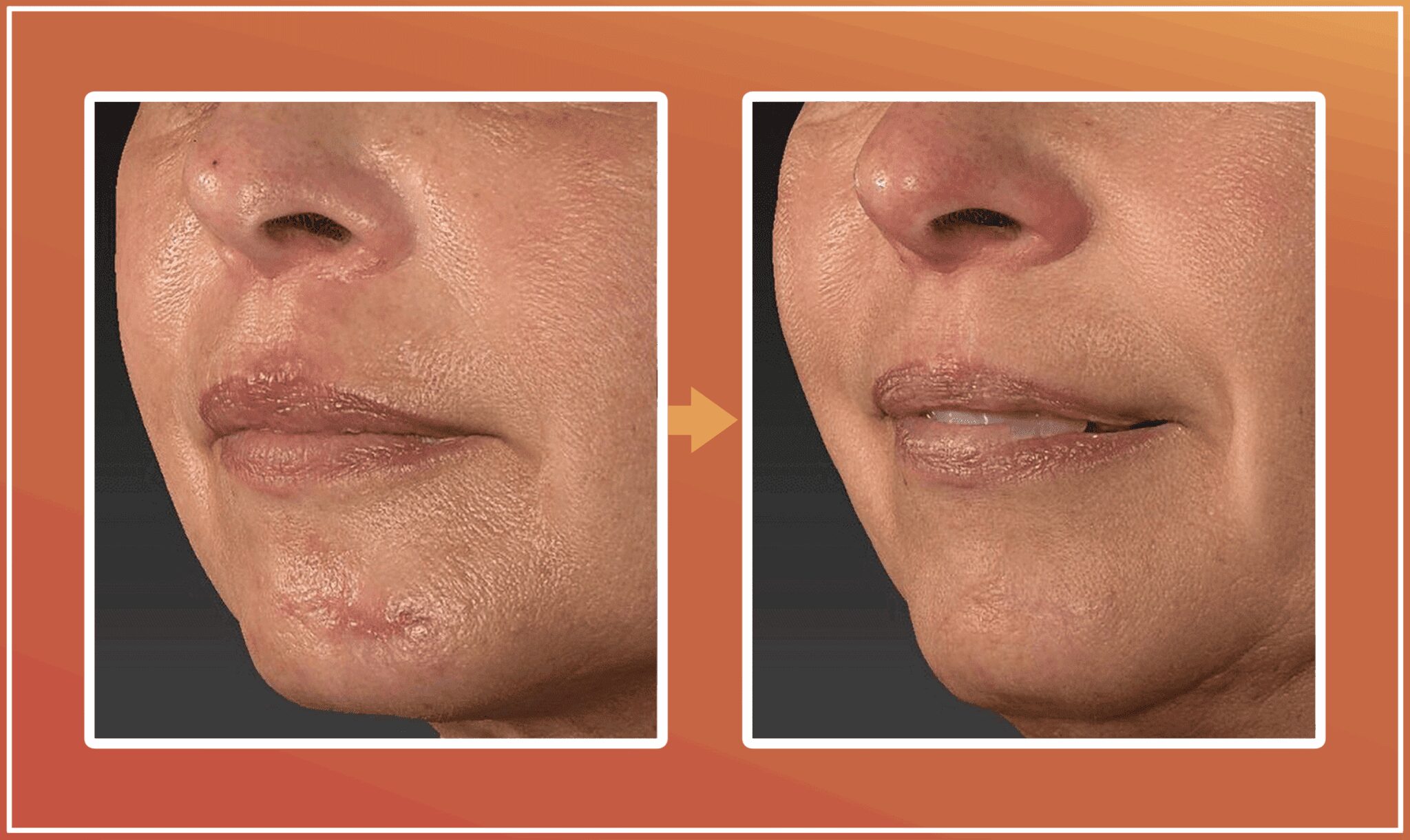 PNR behandeling voor en na foto 1