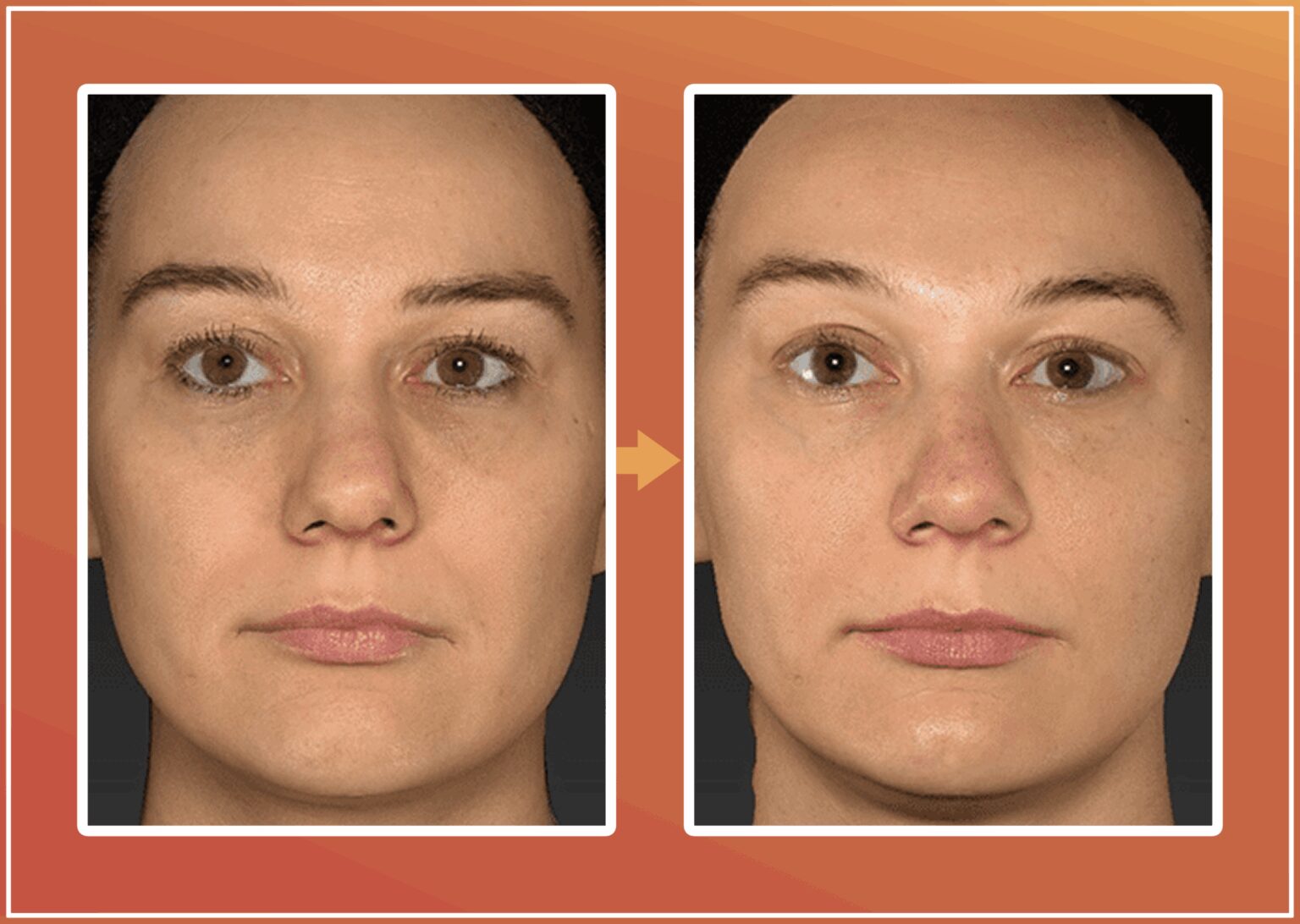 PNR behandeling voor en na foto 2