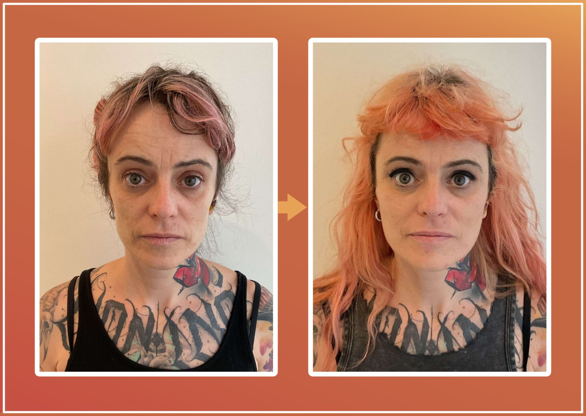 Radiesse behandeling resultaat 2