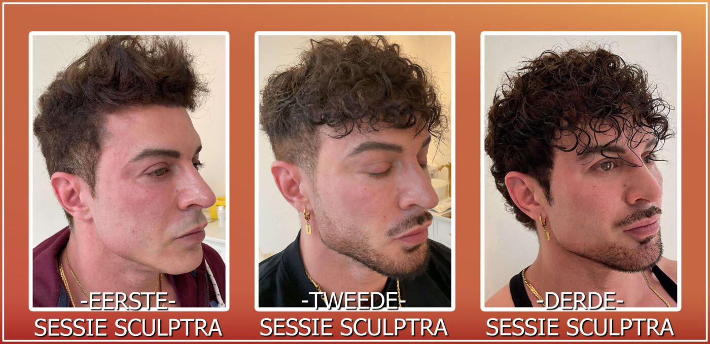 Sculptra eerste, tweede en derde sessie progressie