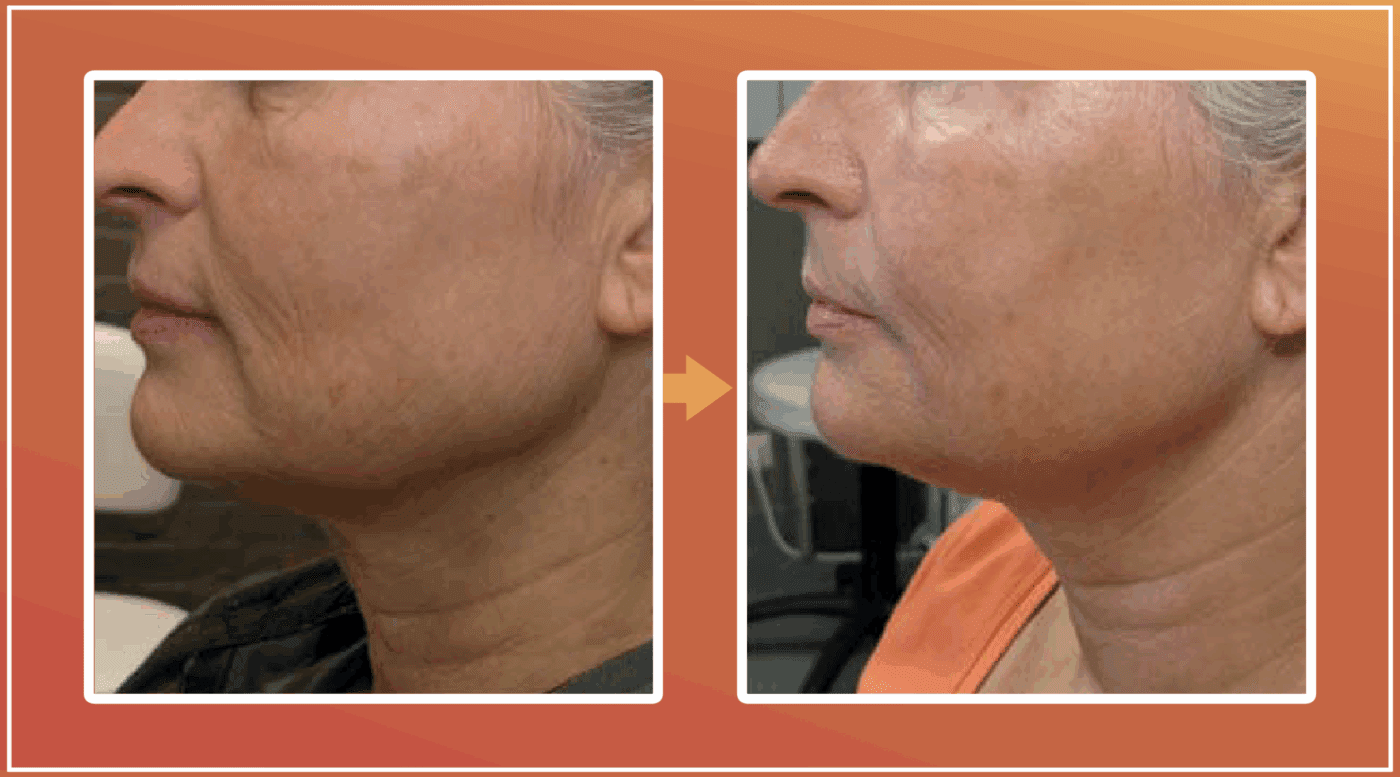 Tixel behandeling resultaat 1