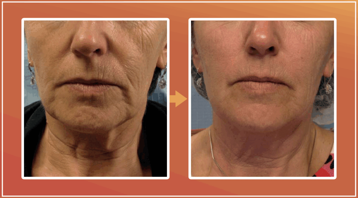 Tixel behandeling resultaat 2